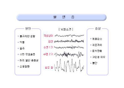 불면증