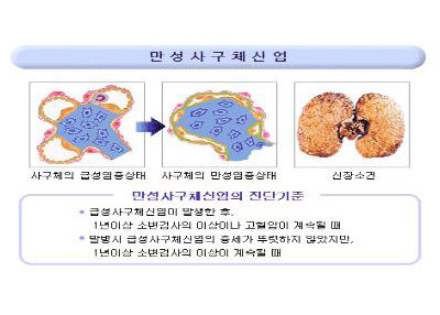 만성사구체신염