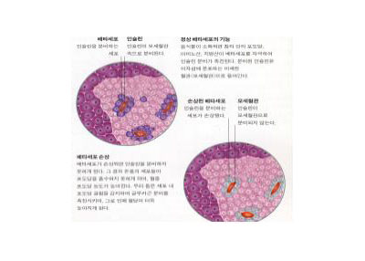 제1형 당뇨병