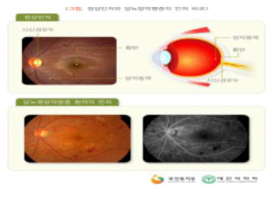 당뇨병성 망막증