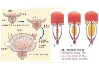전립선 비대증