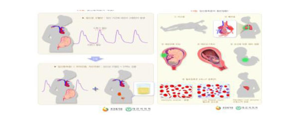 임신 중독증