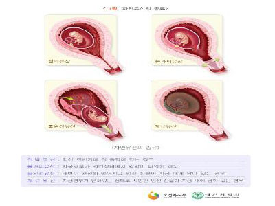 유산