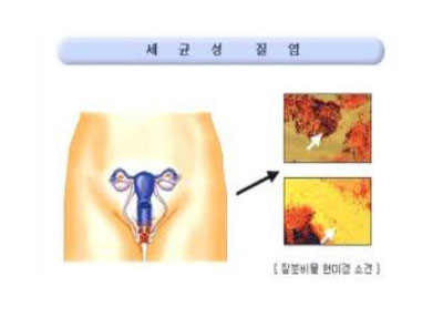 세균성 질염