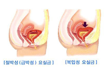 절박 요실금