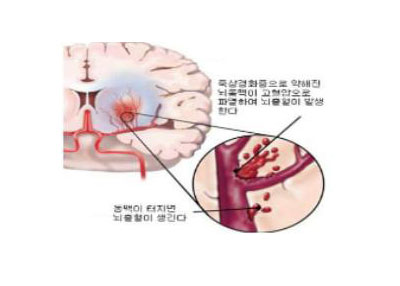 뇌출혈