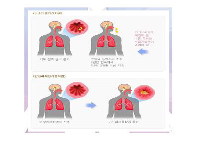 만성기관지염