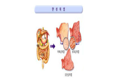 만성 위염