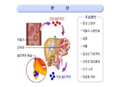 황달