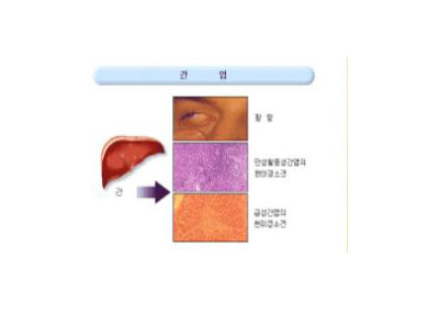 급성간염