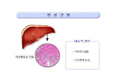 만성간염