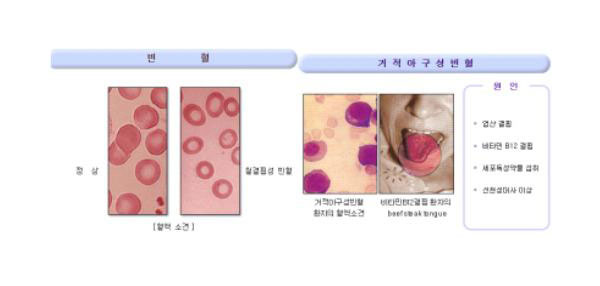 빈혈