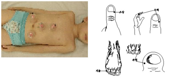 복통/체했을 때 손/발가락 따주기