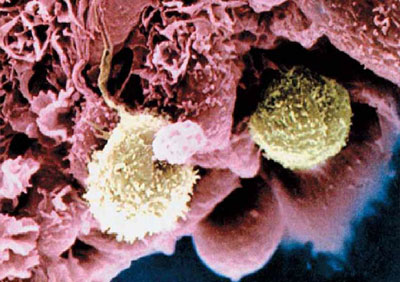 면역세포가 암세포 덩어리와 치열하게 싸우는 모습