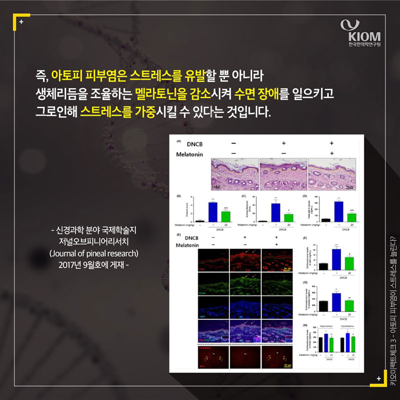 아토피 피부염이 스트레스를 늘린다? 사진 8번