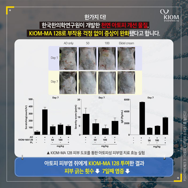 아토피 피부염이 스트레스를 늘린다? 사진 9번