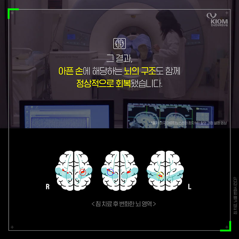 침 치료, 뇌를 변화시킨다? 사진 7번