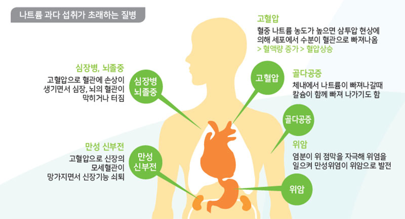 과다한 나트륨 섭취 관련 질병