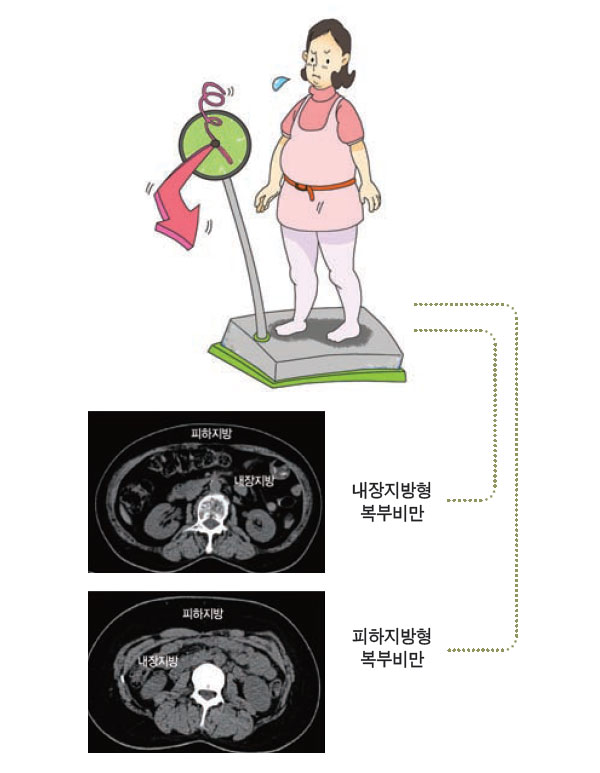 복부비만의 유형