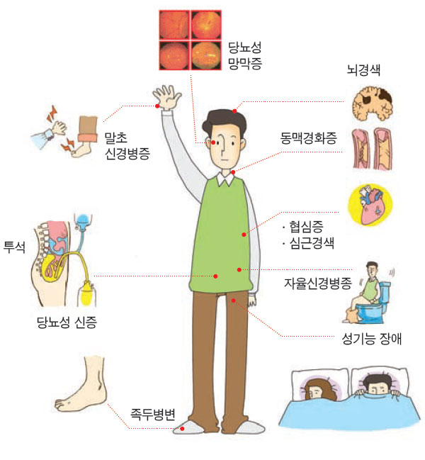 당뇨의 합병증